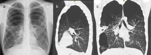 Chest X-ray and chest CT. (a) Posteroanterior chest X-ray shows hyperlucent upper parts of both lung fields, approx. upper half on the right side and upper third on the left side. Residual lung parenchyma has increased bronchovascular markings; (b) Chest CT (sagittal reconstruction) at the level of left hilum shows vanishing lung in the upper third of left lung; (c) Chest CT (coronal reconstruction) at the level of main bronchi shows bronchiectasis in the left upper lobe ending in severe emphysematous changes of lung parenchyma, vanishing lung in both upper zones, large bulla in the right lower lobe and consolidation in basolateral part of the right upper lobe.