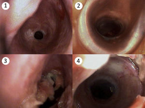 (1) Subglottic tracheal stenosis. (2) Patent