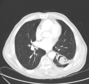 Mass located within the cavity in the left lower lobe, which moved when the patient changed position, showing an air crescent sign.