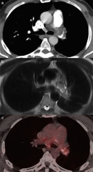 (a) CT angiogram showing total filling defect of the left pulmonary artery and partial filling defect of the right. (b) MRI in T2 showing mildly hyperintense lesion after intravenous gadolinium administration. (c) PET-CT with increased uptake of contrast material at the same region.
