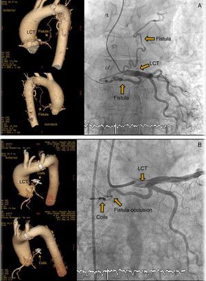(A) Coronary artery fistula from the LCT to the left pulmonary artery. CT and angiography. (B) Percutaneous closure of coronary artery fistula using coils. CT and angiography.