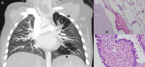 (A) Contrast-enhanced, coronal plane, chest computed tomography. Closed arrows show mucoceles and black arrows show air-trapped segments. (B) Haematoxylin•eosin, í100 magnification. The air trapping areas (open arrow) and mucocele (asterix), confirming bronchial atresia. (C) Haematoxylin•eosin, í400 magnification. CPAM areas (closed arrow) showed by respiratory epithelial lined cysts and a thin fibromuscular layer in the cyst wall.