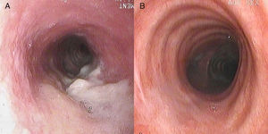 Endoscopic image of the trachea. (A) Diffuse thickening of the wall of the trachea with a necrotic lesion can be observed. (B) Resolution of lesions after antituberculosis treatment.