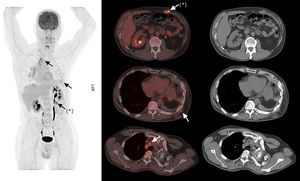 Maximum intensity projection (MIP) image and axial slices from the 18FDG PET-CT, showing hypermetabolic deposits of tracer in the mediastinal lymph nodes and locoregional deposits in the left serratus anterior muscle, the rib cage, and left rectus anterior abdominus (arrows), and changes resulting from surgical history in the left hemithorax. The lesion with the highest metabolic rate was located in the left rectus anterior abdominus (asterisk), with SUVmax 5.7.