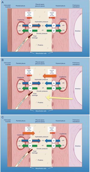 Schematic representation of the movement of fluid in the pleural space in normal conditions (A), in heart failure (B) and in trapped lung (C). In normal lung and pleura (A), the balance of hydrostatic and oncotic pressures promotes the formation of pleural fluid. Pressure gradients show a net flow of fluid from the parietal pleura and that balance is maintained in the visceral pleura (pressures in cmH2O). In heart failure (B), fluid in the pulmonary interstitium increases due to increased pulmonary capillary pressures. Fluid that enters the pleural space exceeds the drainage capacity of the pleural lymphatic capillaries. In trapped lung (C), a previous inflammatory process has produced a thick, fibrous visceral pleura. The inability of the lung to expand leads to a negative hydrostatic pleural pressure and this alteration of the Starling