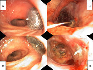 Figures A and B show the moment when the system was placed: (A) shows the view through the flexible fiberoptic bronchoscopy of the successful Amplatzer® placement, after deployment. (B) shows the view through the thoracostomy, at the time of release of the Amplatzer® placement system. Figures C and D show the results 3 months after placement: (C) shows the view through the flexible fiberoptic bronchoscopy of the closed fistula in the RUL stump. (D) shows the view through the thoracostomy.