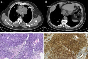 (A) Chest CT showing a pre-vascular solid mass with 9cm in the superior mediastinum (white arrow). (B) Chest CT showing a lesion in the anterior portion of the 7th right rib with 7.9cm and bone destruction (white arrow). (C) Photomicrograph illustrating small-sized round cells with scanty cytoplasm. Stain: hematoxylin and eosin (HE); magnification: 20í (D) Immunohistochemistry photomicrograph showing tumor cells positive for CD99; magnification: 20í.