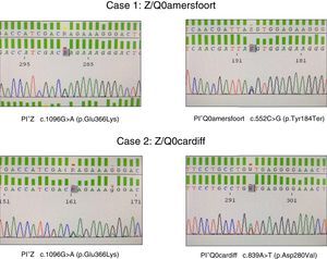 Identification of PI*Q0Amersfoort and PI*Q0cardiff null alleles.