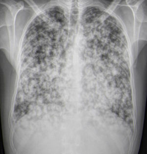 Chest X-ray: bilateral pulmonary nodules, mostly cavitated.