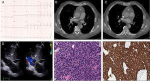 Coronary syndrome as the first manifestation of invasive thymoma.