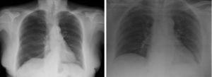 Left: pneumothorax in right hemithorax. Right: pneumothorax resolved after chronic drainage.