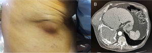 (A) Painful swelling in chest wall. (B) Computed axial tomography showing pleural effusion with calcified surface and rupture with fistulous tract between both collections.