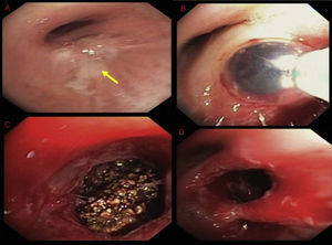 Bronchoscopic images. Raised lesion with granulation tissue at the distal end of bronchus intermedius (panel A). Fogarty balloon catheter being used to dilate the RLL orifice (panel B). Foreign body with brown, irregular surface (panelC). Patent RLL segments after retrieval of the foreign body (panel D).