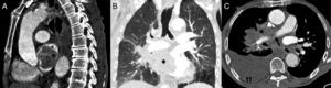 Sagittal (A) and coronal (B) CT scan showing the pulmonary mass invading the left atrium. Axial CT (C) showing the right pulmonary artery involved by the mass and an unilateral large-volume pleural effusion. *: pulmonary mass; arrow: right pulmonary artery; double arrow: right pleural effusion.