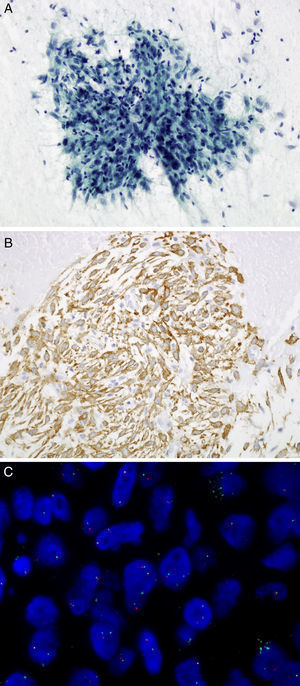 (A) Transbronchial FNA: spindle cells admixed with lymphoplasmacytic cells. Papanicolaou, 20×. (B) Cell block: tumor cells show cytoplasmic expression of the protein ALK using D5F3 antibody. 20×. (C) ALK FISH break-apart probe (Vysis, Abbott Molecular) showing a typical rearranged positive pattern with mainly one fused and one split signals (1F1O1G).