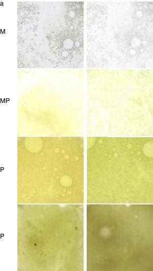 Table to assess the color of sputum from least to most purulent. M: mucous; MP: mucopurulent; P: purulent.