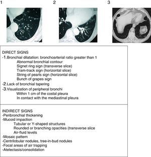 Radiological signs of bronchiectasis (images above the table of the 3 principle criteria or direct signs of Naidich et al.).