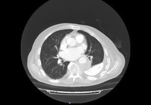 Chest CT slice showing the lesion. An adjacent area of para-aortic pulmonary consolidation and left posterior pleural calcification can be observed.