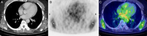 (A) Axial image of the CT component of the PET/CT study showing masses (asterisks) between the tip of the each scapula and the chest wall. Note the latissimus dorsi muscle (arrows) covering each mass. (B and C) Axial images from the PET component (B) and the PET/CT fusion (C) showing subscapular hypermetabolic masses (asterisks).