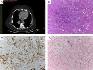 Lymphomatoid granulomatosis. (A) Right single pulmonary nodule and micronodules in the right upper lobe and left hemithorax (chest CT). (B) Large mononuclear cells with the typical angiocentric pattern and abundant tumor necrosis (H&E, ×10). (C) Large B cell lymphocytes surrounding the blood vessels (CD20, ×20). (D) Large B cells positive for in situ hybridization of EBV (EBER, ×40).