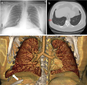 (a) Chest X-ray showing lateral lung herniation (arrow). (b) Axial view of Chest CT in lung window showing lung herniation (arrow). (c) Coronal 3D volume rendered colored image demonstrating widening of the right 8th•9th lateral intercostal rib space with herniation of right lung parenchyma (white arrow).