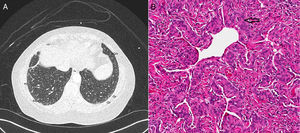 (A) CT chest demonstrates multiple ground glass nodules along the subpleural area and lung periphery in the lower lobes bilaterally (marked with open arrows). (B) Histology on wedge biopsy demonstrates multiple minute pulmonary meningothelial-like nodules with intervening collagen (open arrow) (hematoxylin and eosin; 200×).