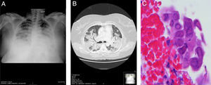 (A) Chest X-ray in decubitus position showing extensive areas of bilateral consolidation. (B) Chest computed tomography showing extensive lung consolidation containing air bronchogram. (C) Bronchial biopsy specimen showing squamous cells with enlarged, occasionally multiple, nuclei, with blurred chromatin (ground glass effect), typical of herpes virus infection (H.E. 400×).