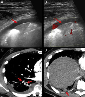 Chest ultrasound and computed tomography showing a filling defect in the segmental arteries of the RLL, and pleural-based, triangular subpleural consolidation, diagnosed as pulmonary thromboembolism with pulmonary infarction.