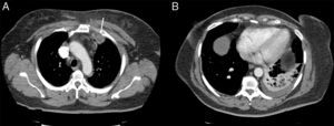 Pseudonodular image in the space between the first and second left costal arch (arrow), and simultaneous consolidation in the left lower lobe.