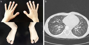 (a) Digital clubbing in fingers and toes. (b) Follow-up lung CT showing progression of the ground glass pattern and appearance of new cystic lesions.