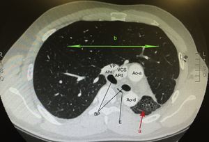 Axial image of the chest CT showing (a) left lung with marked reduction of volume and bronchiectasis, corresponding to pulmonary hypoplasia, and (b) large compensatory hyperinflation of the right lung; Ao-a: ascending aorta; Ao-d: descending aorta; RPA: right pulmonary artery; MB: left and right main bronchi; E: esophagus; SVC: superior vena cava; PV: pulmonary vein.