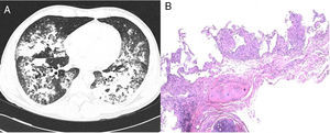 (A) Chest CT: pulmonary consolidations in middle lobe, lingula, and both lower lobes. (B) Transbronchial biopsy of the right lung base: evidence of non-necrotizing granulomatous pneumonitis (hematoxylin-eosin staining, 4×).