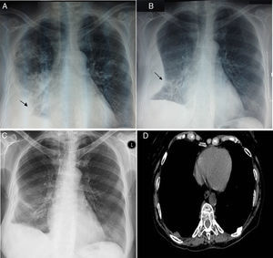66-Year-old woman with systemic lupus erythematosus presenting with acute lupus pneumonitis. (A) Chest X-ray showing right pleural effusion (asterisk) and pulmonary consolidation in right upper lobe. (B) On the chest X-ray three days later, a right encapsulated pleural effusion (asterisk) was observed. (C) Practical disappearance of encapsulated effusion in the thoracic study two months later, with a thickening of the right costal pleura and a lateral costophrenic sinus. (D) Axial section of the computed tomography study at 6 months, at the level of the pulmonary bases with a mediastinum window was normal.