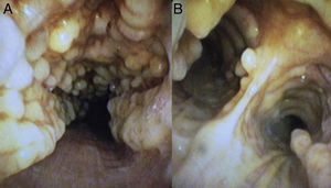 Bronchoscopy image of the trachea (A) and the main carina (B), showing irregular cartilaginous protrusions in the lumen, with no involvement of the pars membranosa.
