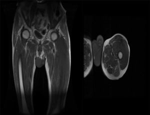 A musculoskeletal MRI images: on the left, a coronal slice and on the right a sagittal slice, showing the extension of tumor.