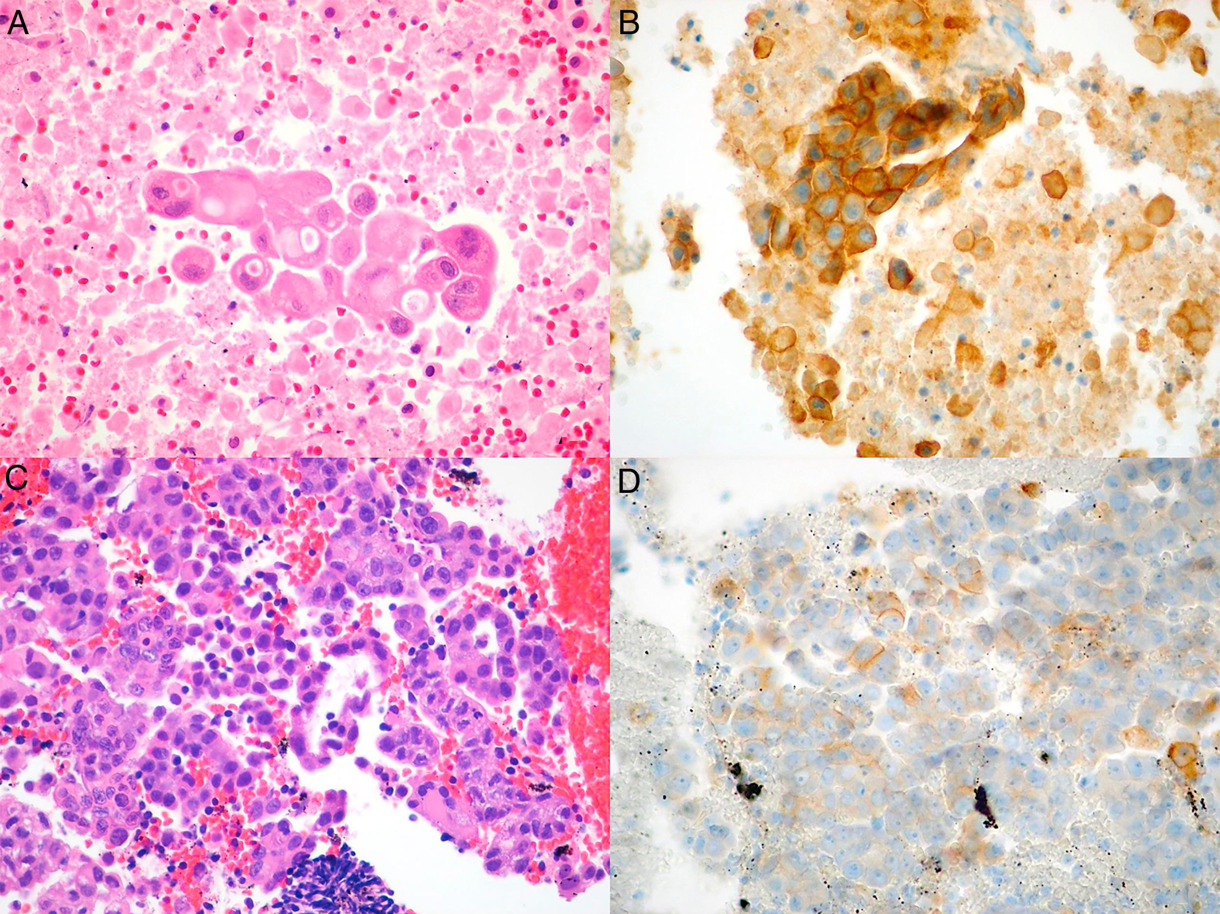 PD-L1 Expression in a Non-Small Cell Lung Cancer Specimen Obtained by ...