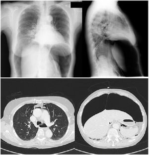 PA chest X-ray and axial CT showing pneumoperitoneum and pneumomediastinum.