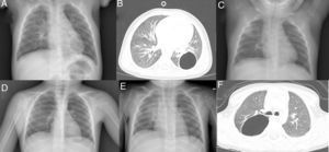 (A) PA chest X-ray: unilocular air cyst in left lung base. (B) Chest CT: thin-walled air cavity in left lower lobe. (C) PA chest X-ray: increased density in right upper lobe of the lung. No cystic lesion is observed. (D) PA chest X-ray: unilocular air cyst in right lung. (E) PA chest X-ray: increased density in right lung. (F) Chest CT: image of thin-walled unilocular cyst containing air, located in the apical segment of the right lower lobe.