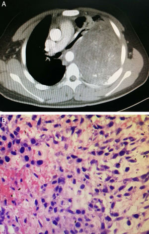 (A) Chest CT showed the heterogeneous mass in the left thoracic cavity. The hyperdense areas are calcification and irregular ossification. Several non-enhanced hypodense areas considered to be necrosis or hemorrhage. (B) Histopathology confirmed the diagnosis of mesenchymal chondrosarcoma (H&E ×200).