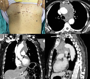 (A) Photograph showing multiple eruptive seborrheic keratoses in the patient