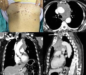 (A) Photograph showing multiple eruptive seborrheic keratoses in the patient's trunk. (B) Axial, (C) coronal and (D) sagittal computed tomography images showing a heterogeneous mass in the anterior mediastinum in close contact with aorta, partially compressing the left pulmonary artery. The mass also infiltrate the left paratracheal space, through the aortopulmonary window, determining elevation of the left hemidiaphragm, probably due to a phrenic nerve injury. Left necrotic supraclavicular lymph-node enlargement (arrows) is also visible.