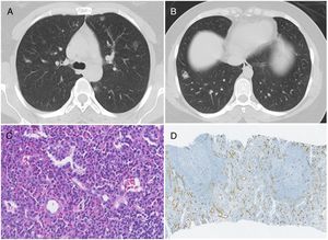 (A) Chest CT showing bilateral pulmonary nodules, predominantly in ground-glass. (B) Chest CT showing a nodule at the base of the right lung, which was biopsied. (C) Photomicrograph illustrating lymphocytes and prominent eosinophilic background; Stain: hematoxylin and eosin (HE); magnification: 40í. (D) Immunohistochemistry photomicrograph showing numerous small-caliber vessels positive for CD34; magnification: 10í.
