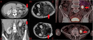 (A) Axial and coronal computed tomography: musculoskeletal metastasis on the left abdominal oblique muscle. (B) Axial T2 magnetic resonance image: musculoskeletal metastasis on flexor digitorum superficialis muscle of the hand; (B1) pre-treatment; (B2) post-treatment. (C) Chest PET-CT: musculoskeletal metastasis on the left iliopsoas muscle.