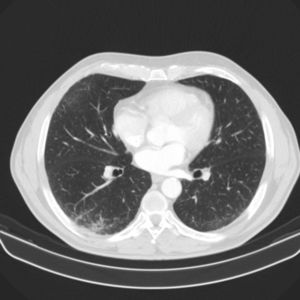 Chest CT showing multiple micronodules.
