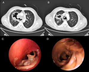 (A and B) Chest CT showing significant concentric thickening of the tracheal wall and main bronchi, with vastly irregular tracheal and bronchial luminogram. Necrotic masses are also observed, mainly in the right hemithorax, contiguous with the bronchus of the right upper lobe. (C and D) Bronchoscopy images: (C) tracheal stenosis with friable mucosa and protrusion of fragments of cartilage; (D) division of left upper lobe and lower lobe bronchi, showing mucosa with mammilated areas.