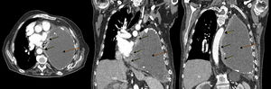 Chest CT with contrast medium, axial (left) and coronal slices (center and right): pleural mass in the medial portion of the anterior left chest wall with pericardial infiltration (solid arrows), and a large collection in the left hemithorax, corresponding with chronic pyothorax (dotted arrows), together causing contralateral mediastinal shift and cardiac compression.