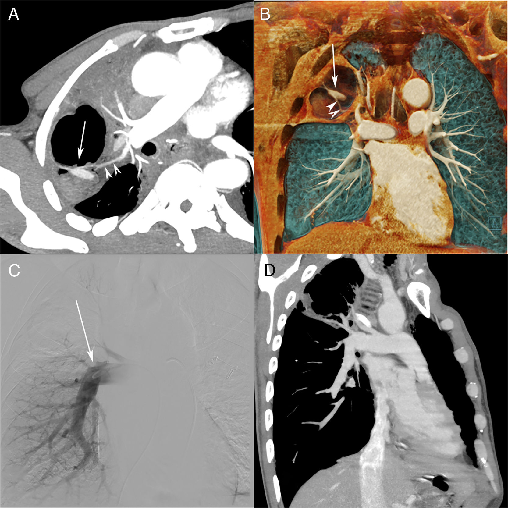Spontaneous Regression of an Infectious Pulmonary Artery Pseudoaneurysm ...