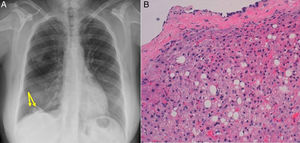(A) Chest X-ray showing two right supradiaphragmatic nodules (arrows). (B) Hepatic tissue with mild steatosis, immersed in a fibroconnective tissue coated with mesothelial cellularity (diaphragmatic parietal pleura) (H&E 20×).