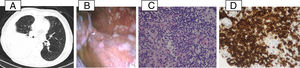 (A) Chest CT (axial plan (AP)): extensive right pleural effusion conditioning almost complete atelectasis of the middle and lower lobes. No mediastinal or hilar pulmonary lymphadenopathies were found. (B) Medical thoracoscopy: pericentrimetric macular lesions with multifocal distribution and stony consistency. (C) Small to intermedium lymphocytes with nuclear irregularity, admixed with mesothelial cells, H&E 400í. (D) Diffuse expression of CD20 in the neoplastic cells, 400í.