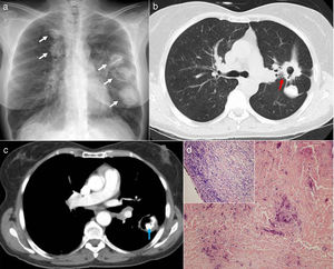 (a) Standard chest X-ray: multiple nodular images in both lung fields, some cavitary; (b) chest CT scan (pulmonary parenchyma window): pulmonary nodules with central cavitation and pleuroparenchymal retraction (arrow); (c) chest CT scan (mediastinum window): cavitary nodule with amorphous internal calcification (arrow); and (d) histology, showing a formation of dense collagen tissue with central calcium microdeposits and accumulations of lymphocytes in the central and peripheral areas (hematoxylin–eosin 40×).
